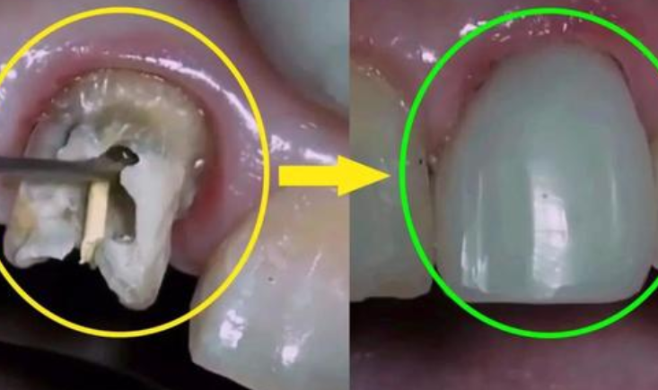 怎麼判斷蛀牙是否爛到牙神經了爛到神經還能補牙嗎