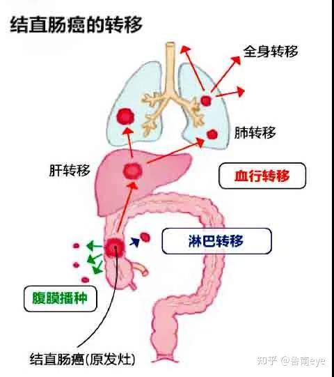 结直肠癌 千万别不当回事 知乎