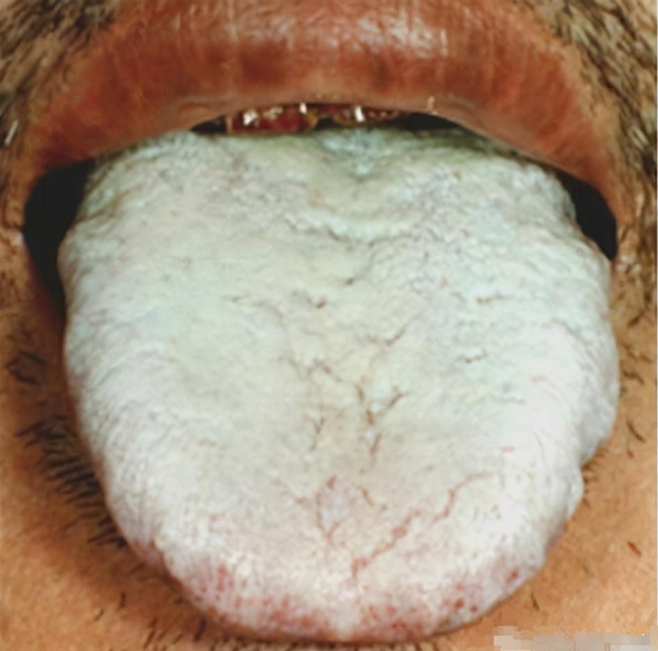 肝硬化病人的舌头图片图片