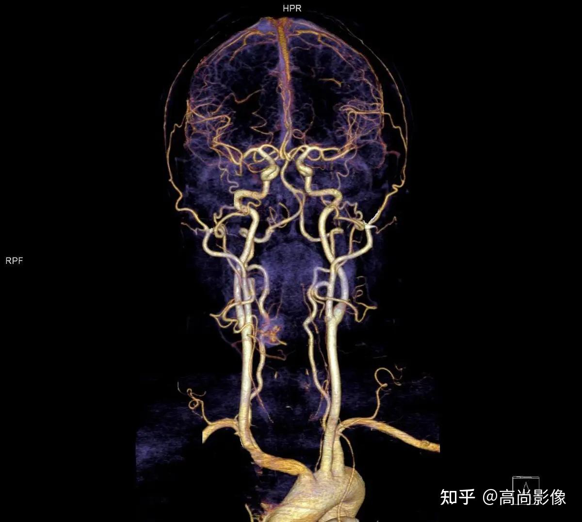 下頜部血管瘤cta雙期顯像,完美展現動,靜脈流入及流出血管關係,為臨床