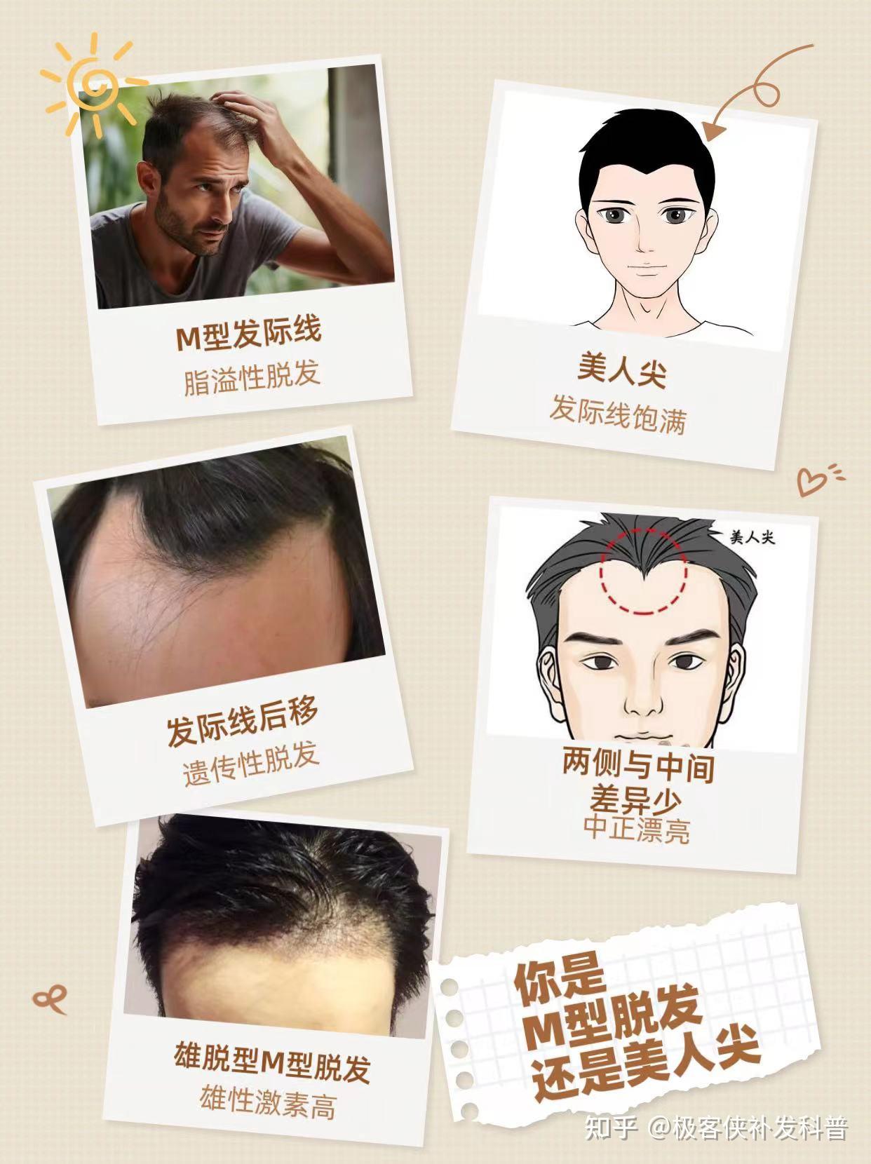 发友如何辨别自己的发际线是美人尖还是脱发 - 知乎