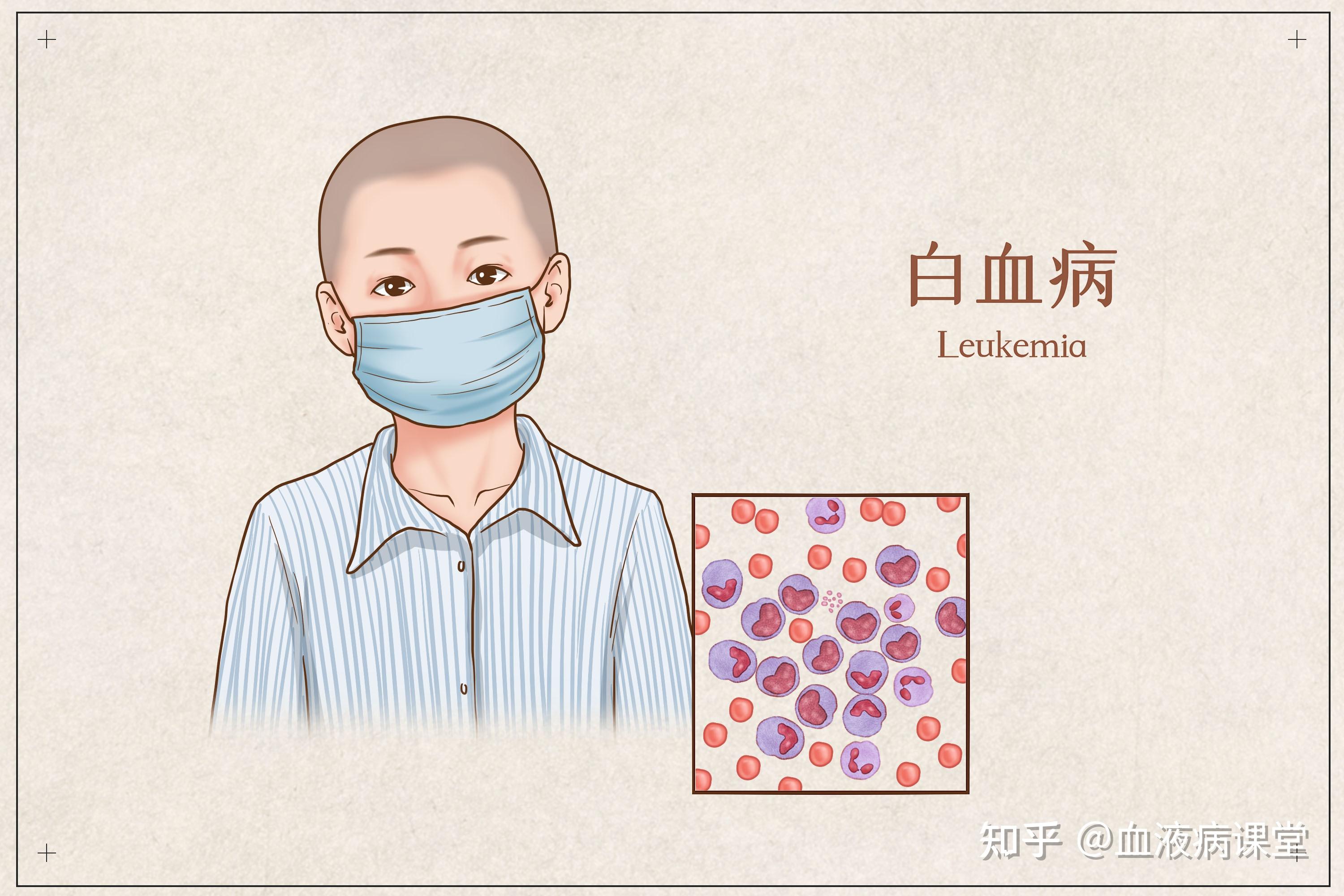 ALLの蔓延は生存率にどのような影響を与えるのでしょうか?