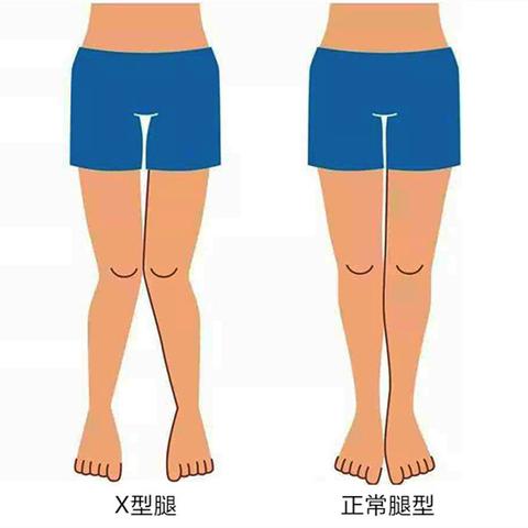 医学上称之为"膝外翻",实质是由于股骨内收,内旋和胫骨外展,外旋