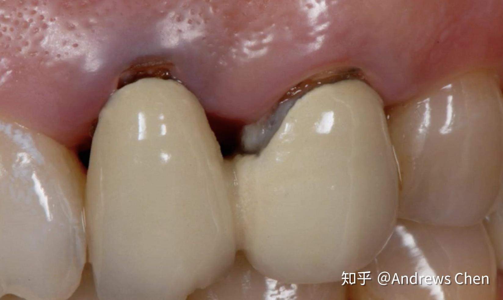 💖MOMO美妝💖可塑性固體牙膠 牙科粘合剂 假牙材料 4D牙膠 牙齒修補材料 堵牙洞縫 牙洞材料填充劑 臨時假牙假牙黏著 | 蝦皮購物