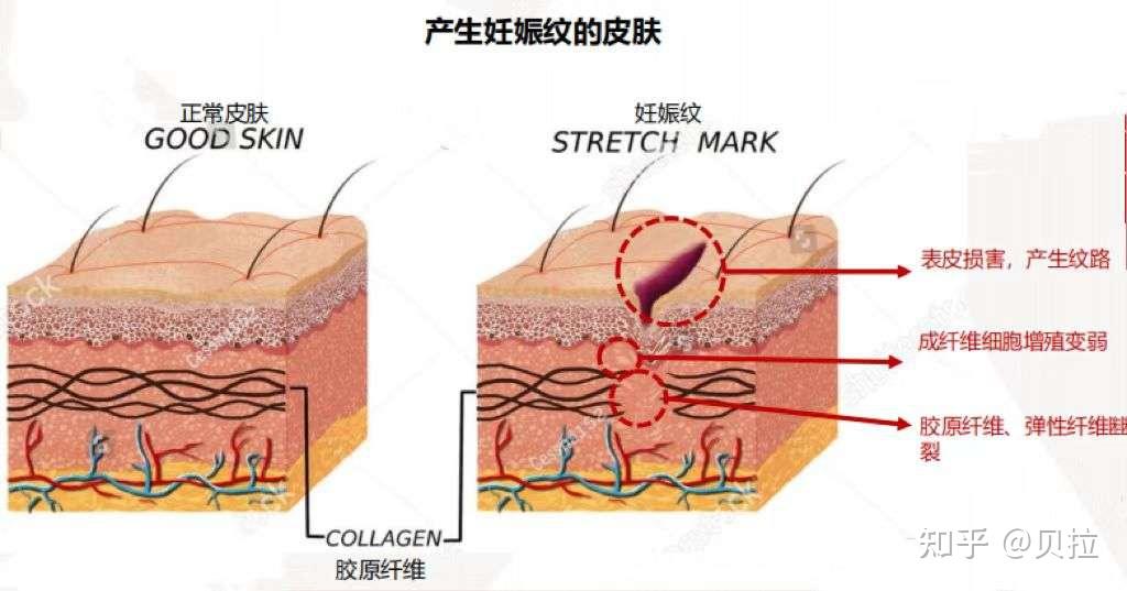 商家的嘴骗人的鬼要想不被割韭菜还是得知道妊娠纹到底是啥全网最简单