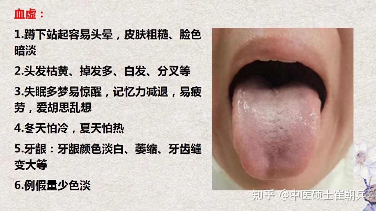 肾阴虚、肾阳虚、气虚、血虚症状和舌象都是什么样呢 - 知乎
