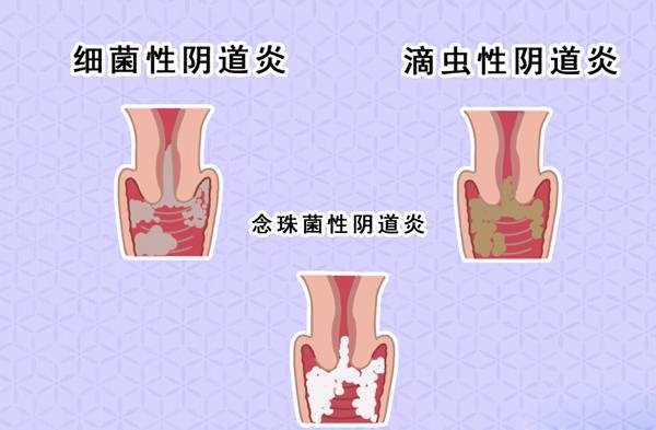 霉菌性阴道炎和细菌性阴道炎有何区别？很多人都不知道！ - 知乎