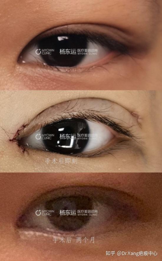 内眼角修复术案例