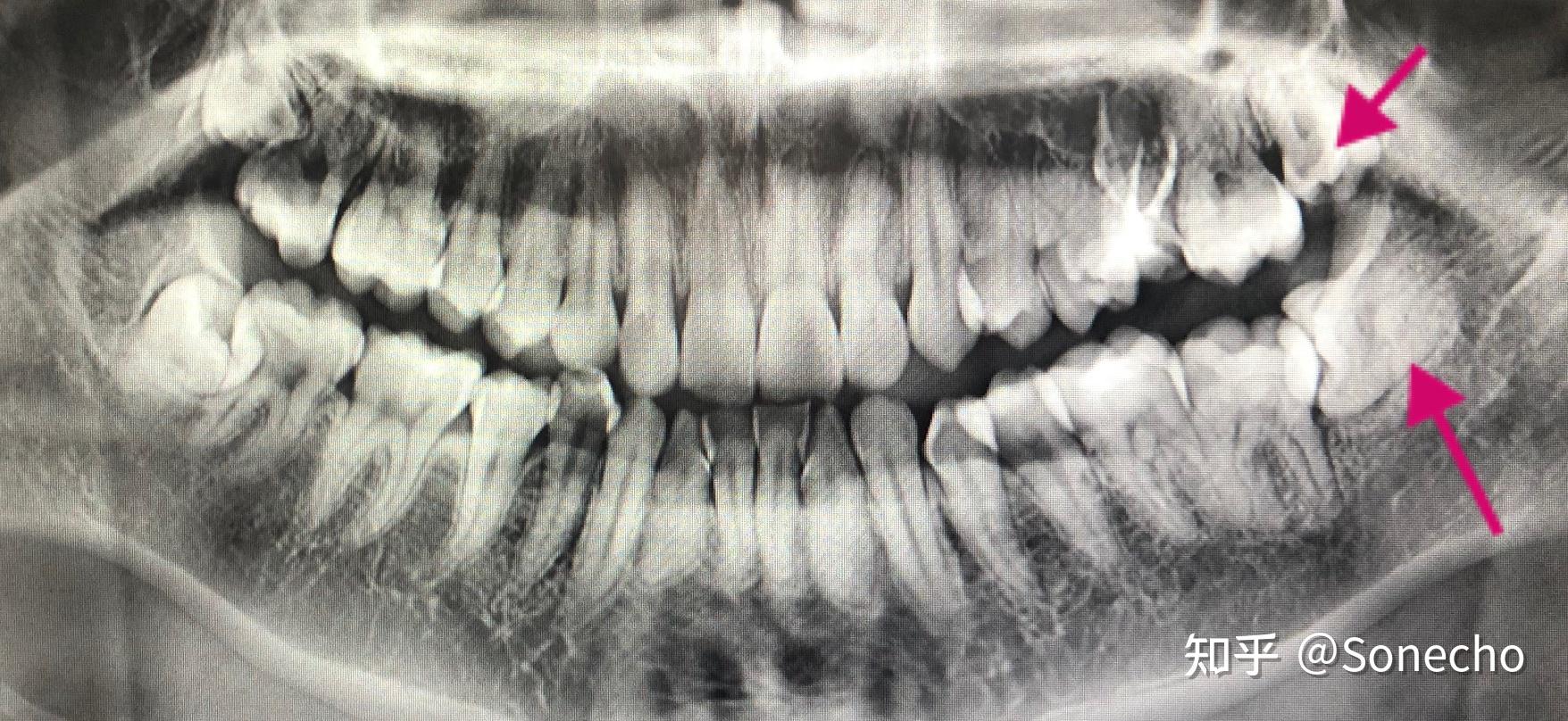 牙齿矫正，凸面型，低角，深覆合，骨性II类，安氏II类二分类（2021.9月至今） - 知乎