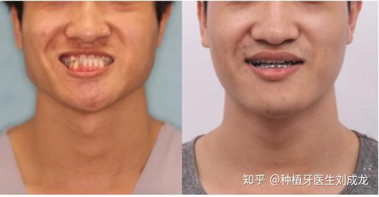 坐标郑州求推荐地包天矫正效果比较好的医生