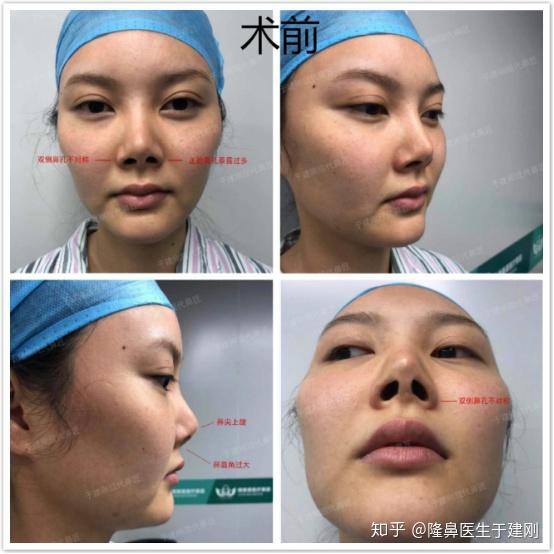 怎样才算是朝天鼻 v2-dd4a0c775807bccc439a4699140a88fb_r.jpg