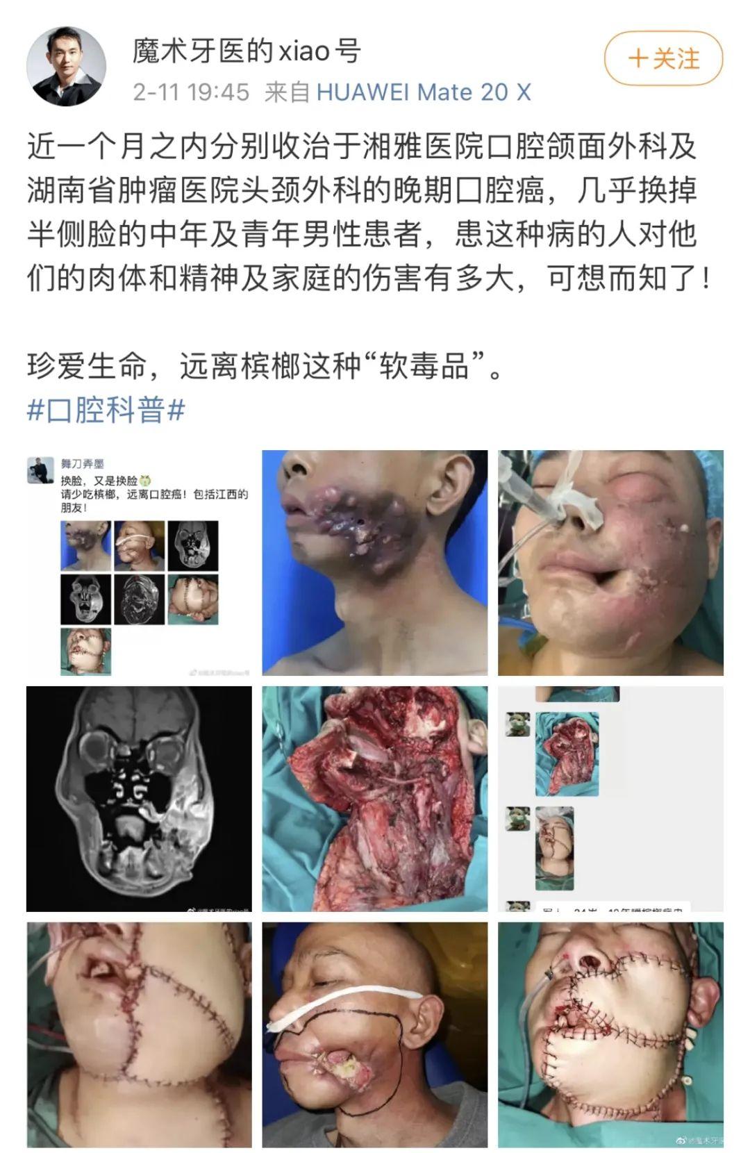 这是一张台湾地区的戒槟榔宣传海报,其中人物嚼槟榔得口腔癌后,原本