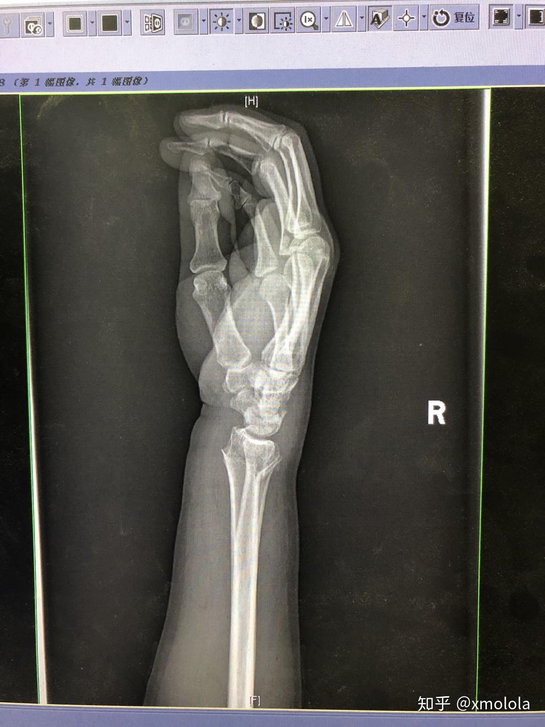 右尺桡骨远端骨折中医表姐手法复位治疗记二图片