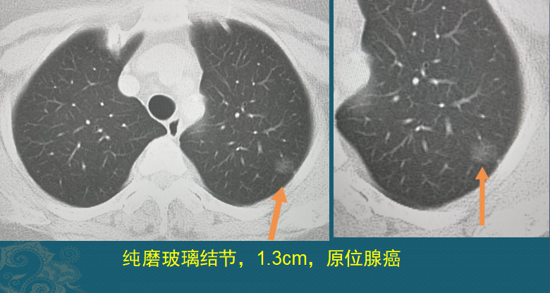 磨玻璃结节就是肺癌吗?医生用ct片详细说明