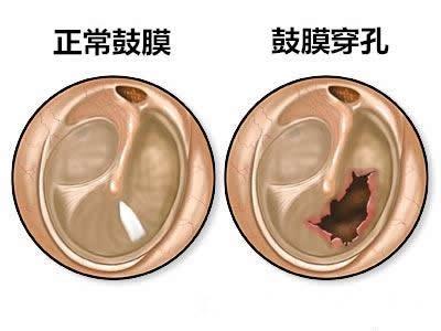 鼓膜穿孔的症状 知乎 鼓膜穿孔的症状 知乎