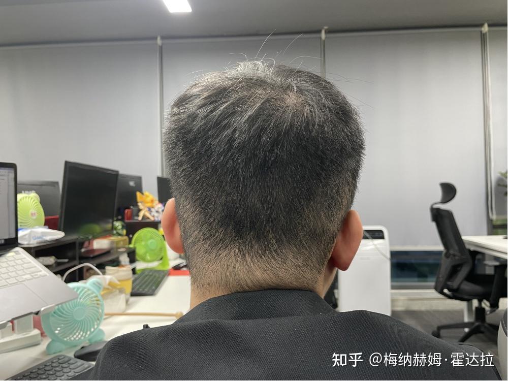 脂溢性脱发必须要植发么(脂溢性脱发的人植发有效果吗)