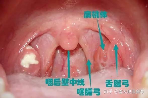 详细来说,扁桃体作为人体免疫器官,可以分泌抗体和淋巴细胞,对细菌