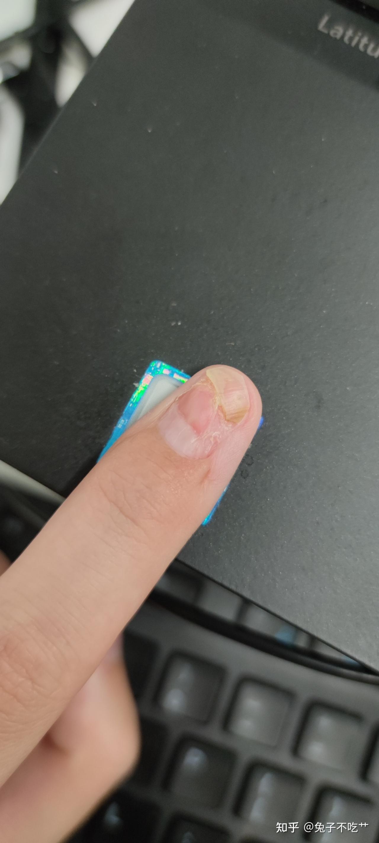 甲母痣做完了给有同样困扰的小伙伴一个参考