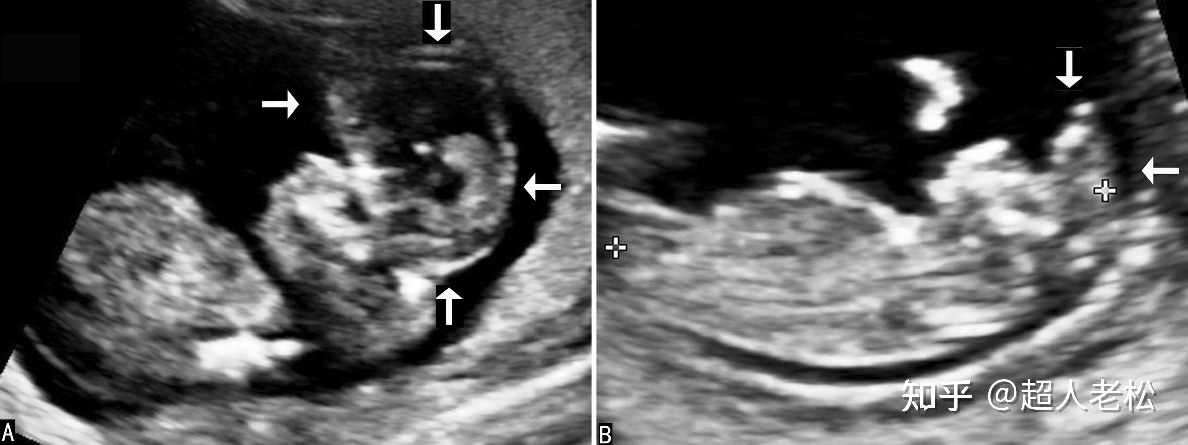 避免胎儿透明隔腔异常诊断的4个误区_分析