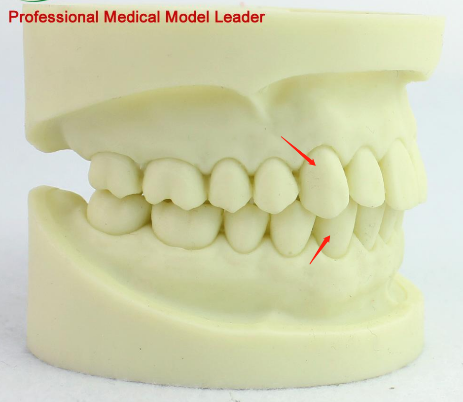 安氏一二三类错牙合都是什么样的?