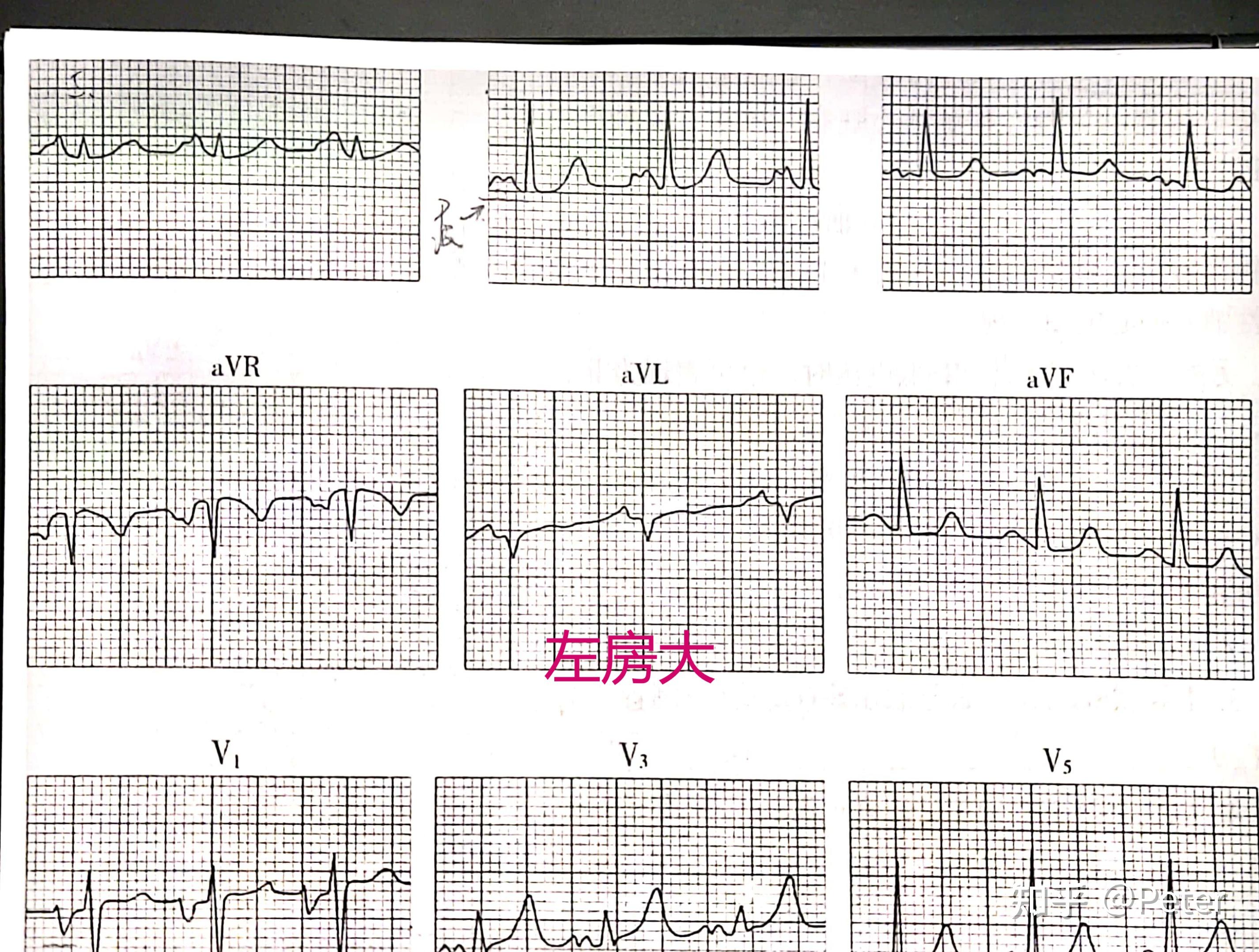 v3rv4rv5r导联心电图图片