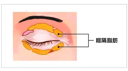3 人 赞同了该文章 我们眼睛的周围分布着很多脂肪团,它叫做眶隔脂肪