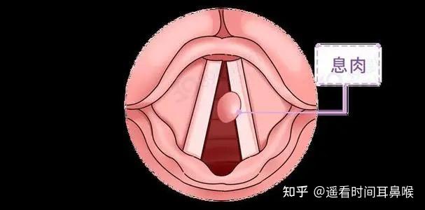 老师们的声带息肉长期不治会引发哪些病变?