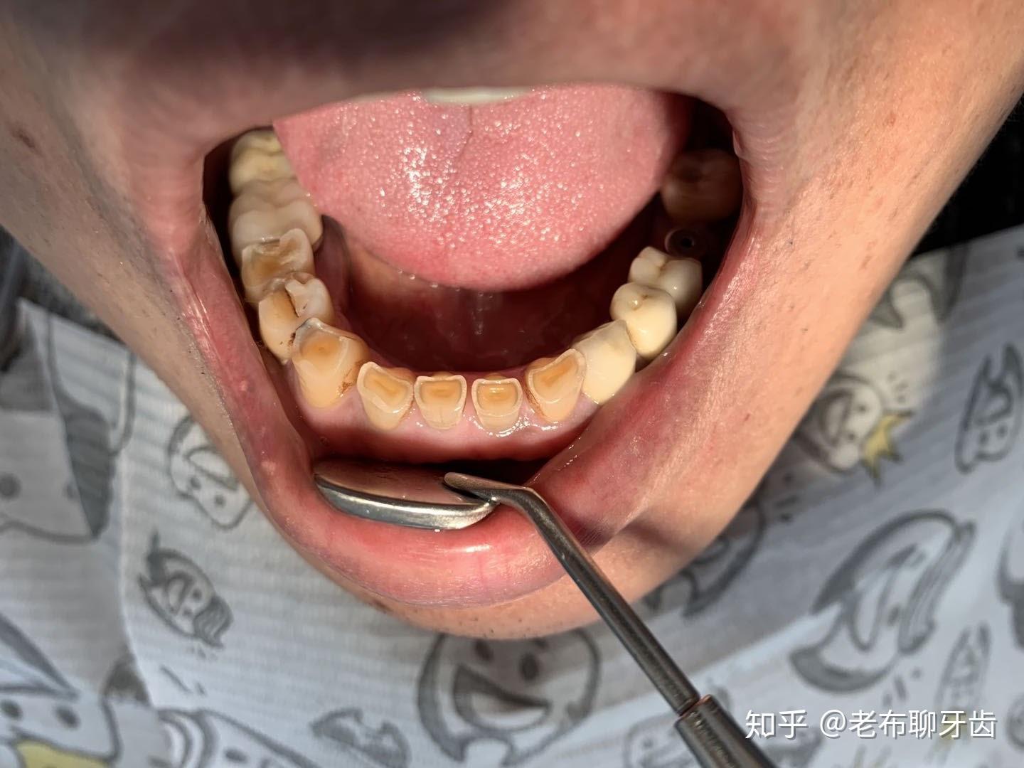 缺牙后，该选择哪种牙齿修复方式?_深圳爱康健口腔医院