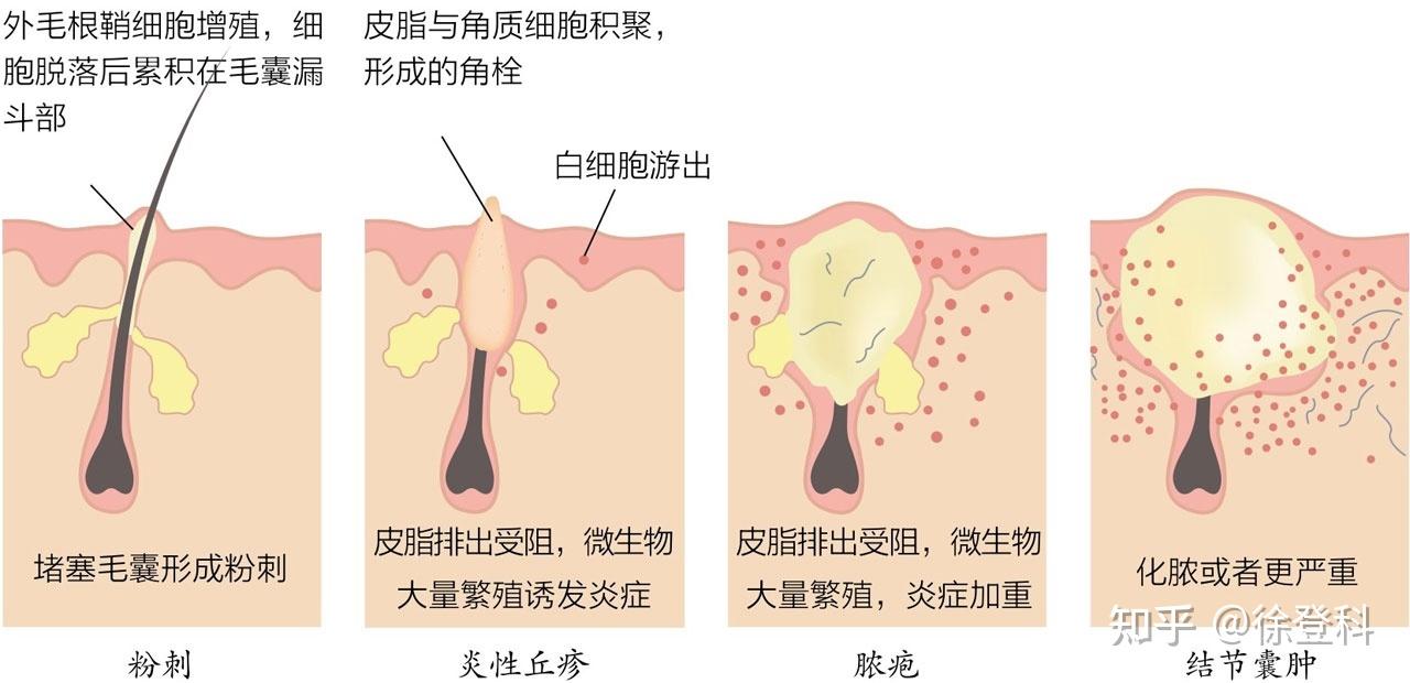 粉刺是怎么形成的图片图片