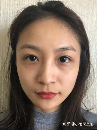 千万别打童颜针看本姑娘分享童颜针一个月后效果图惊