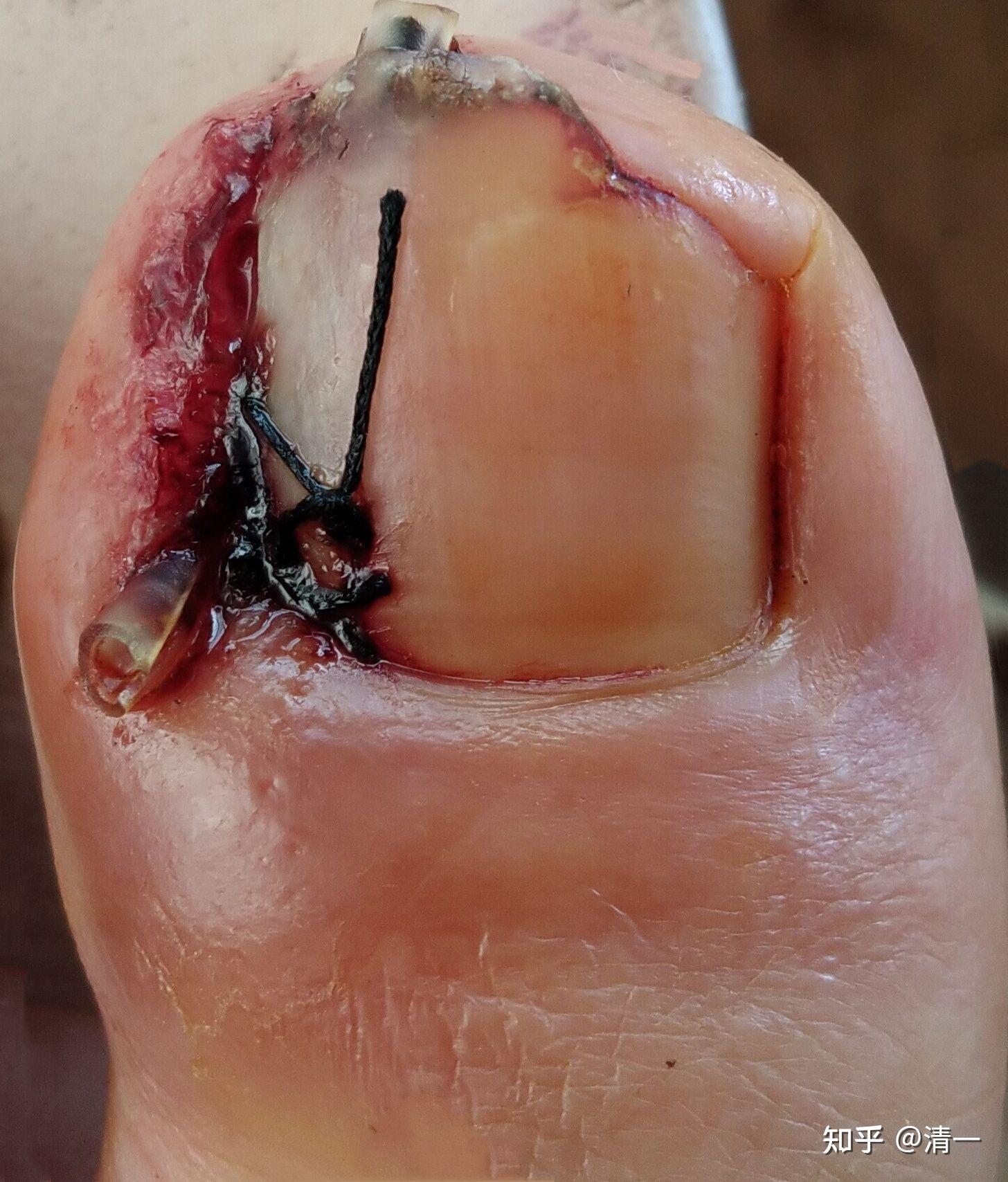 关于甲沟炎治疗方法