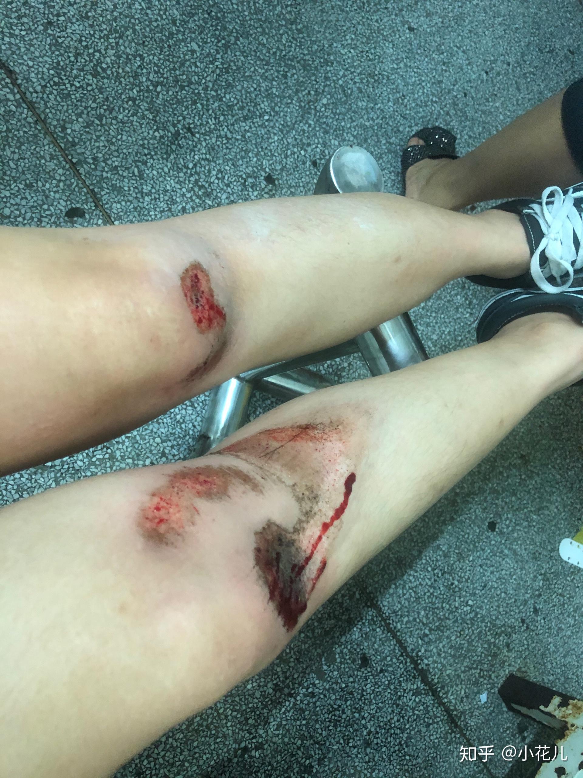 双膝擦伤恢复去疤纪录贴