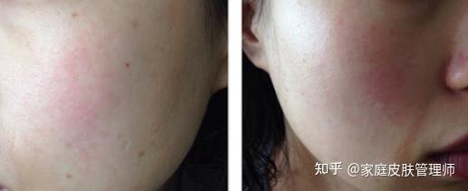 油皮敏感肌痘痘肌用什么牌子的护肤品好