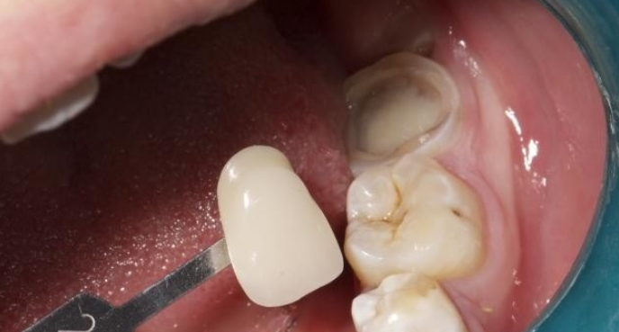 牙齿磨了做了牙套胀痛怎么办牙医这2种情况一定要注意