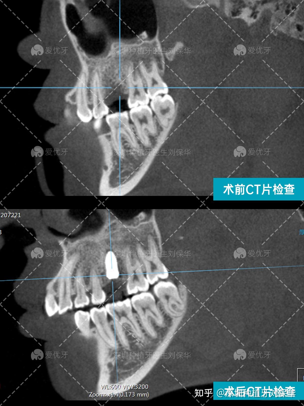 深圳正畸種植牙種植牙後是否可以做牙齒矯正