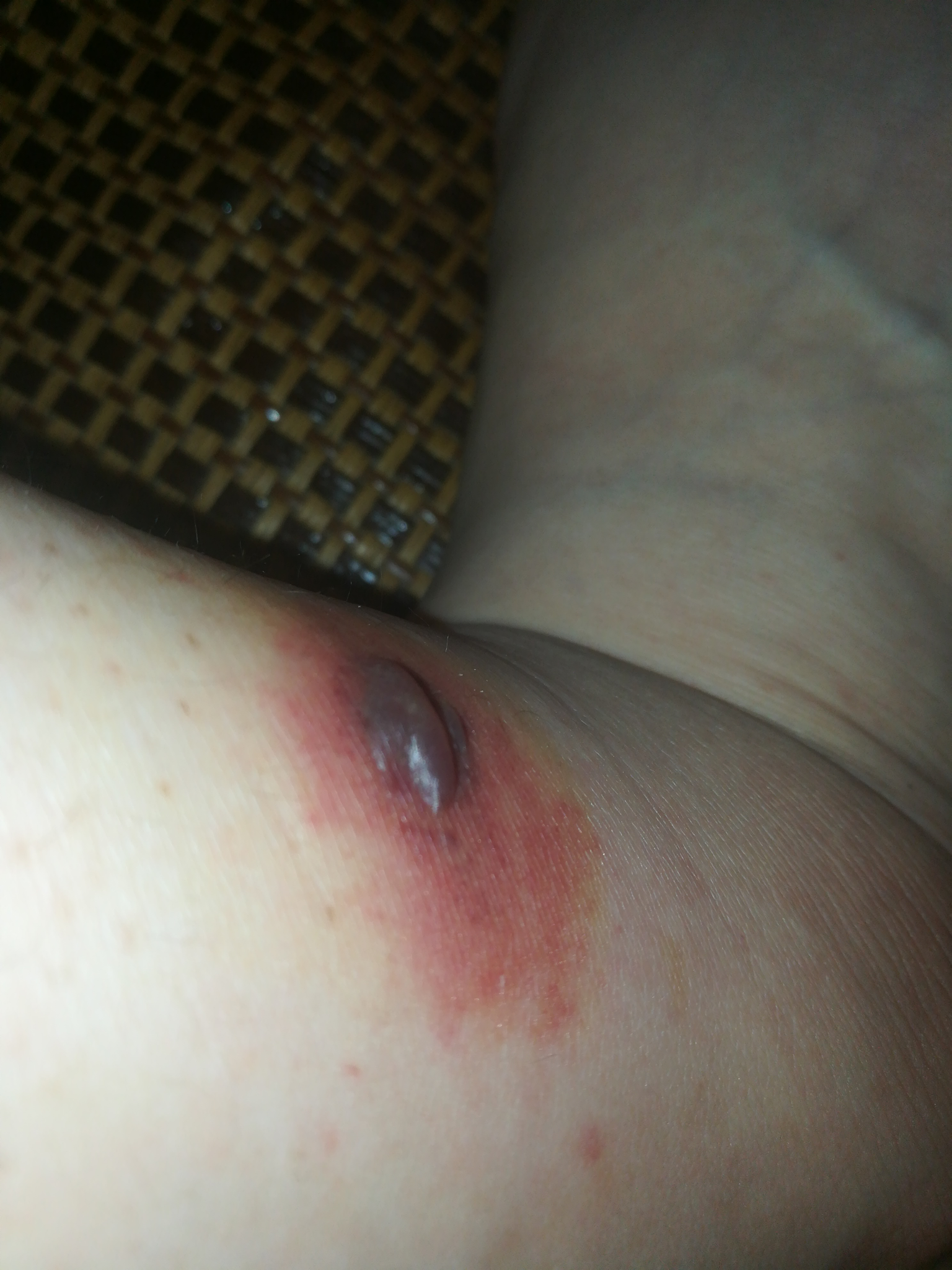 被毒蚊子咬了 肿了很大一个包 还很硬 之后肿的包上面起了水泡 挑破