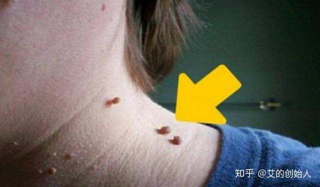 都见过这种小肉球这是湿气导致艾灸这两穴全搞定