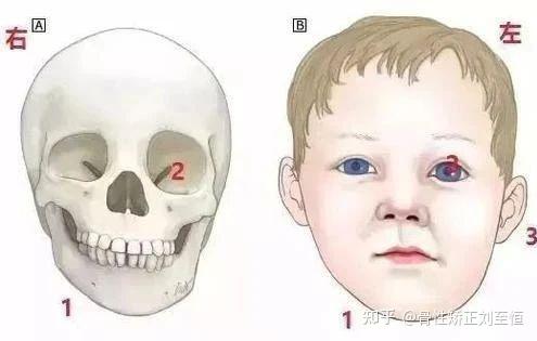 恒牙咬合异常,影响孩子的面部发育,让原本可爱的孩子发生颌面部畸形