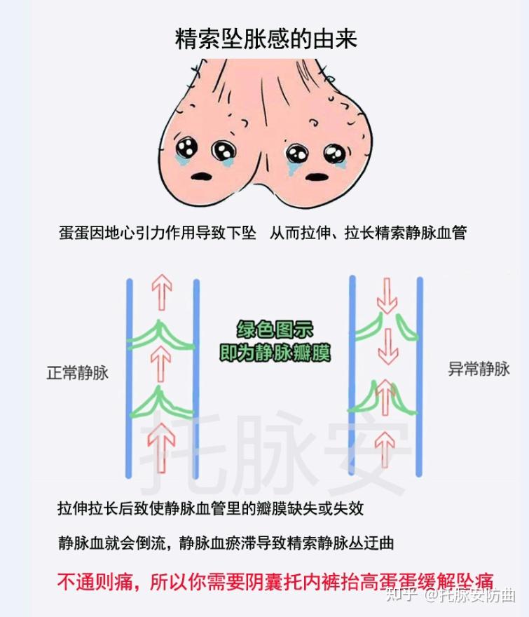 为什么有人轻度精索静脉曲张坠痛,有人重度却不痛? - 知乎