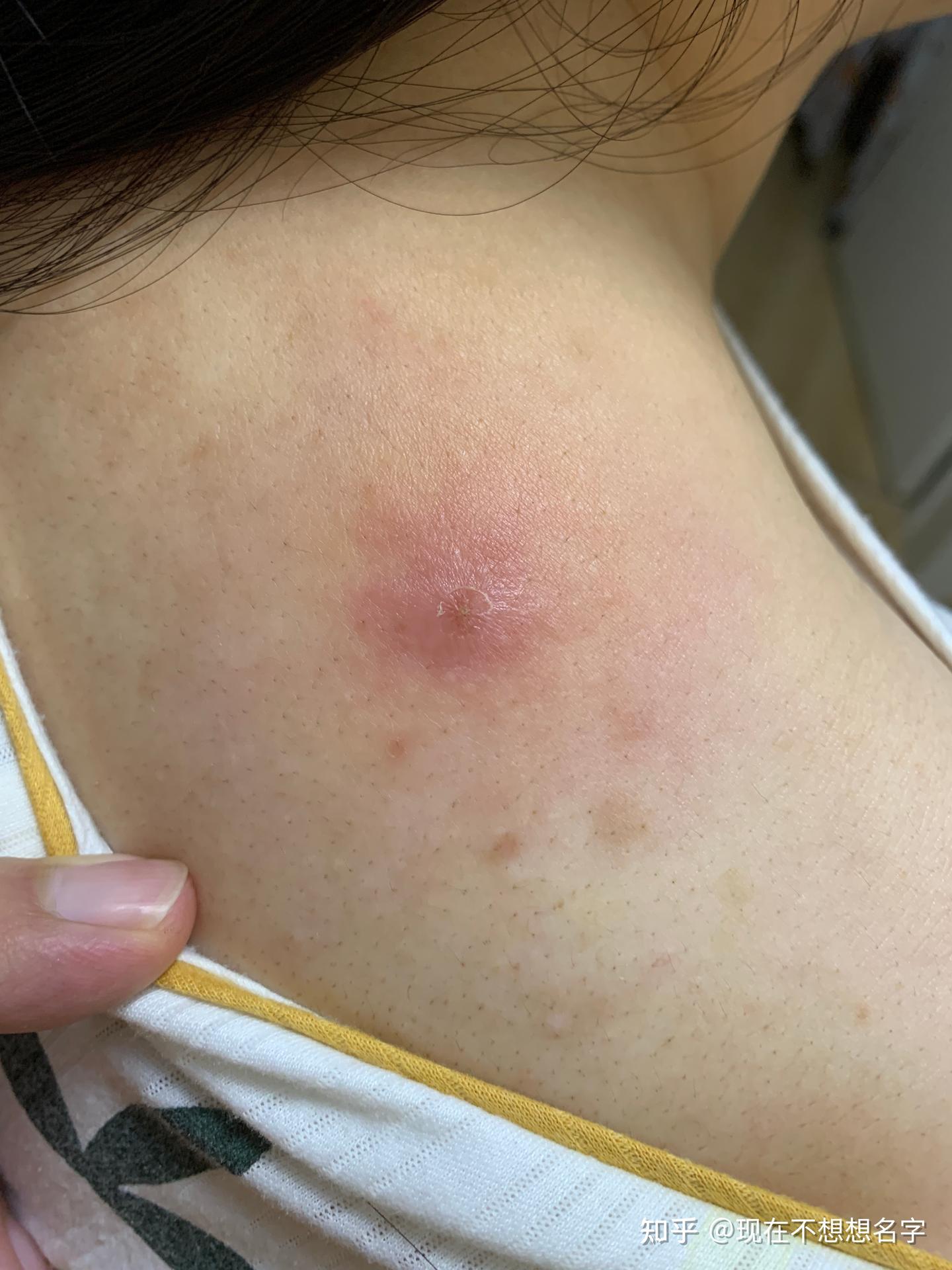 自己处理两次不同的火疖子 - 知乎
