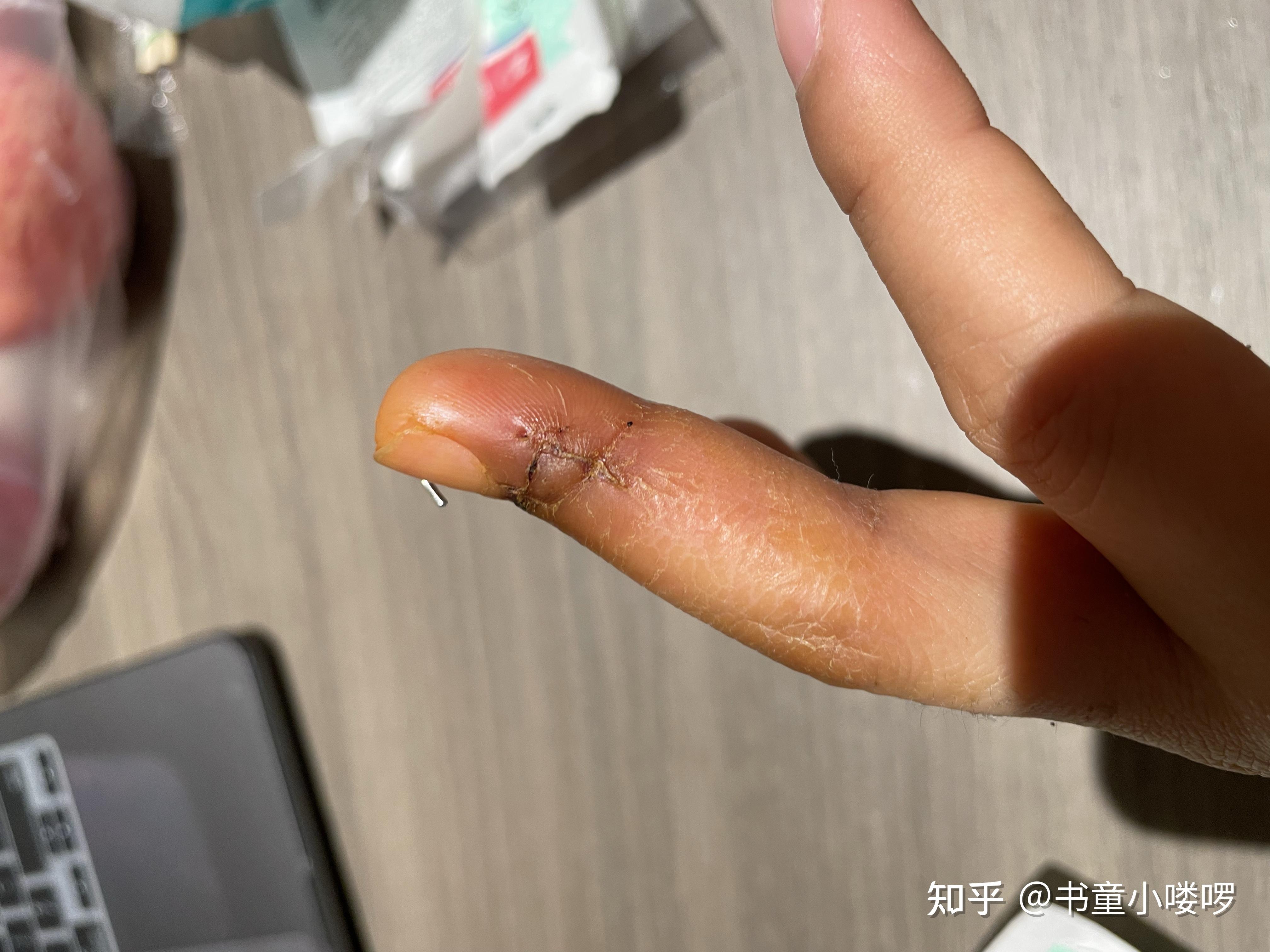 手指肌腱断裂恢复过程