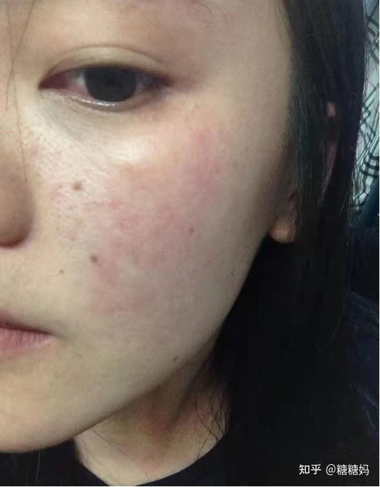 烂脸n1次后我终于实现了不爆痘不爆皮的孕妇护肤品自由含2022最好用的