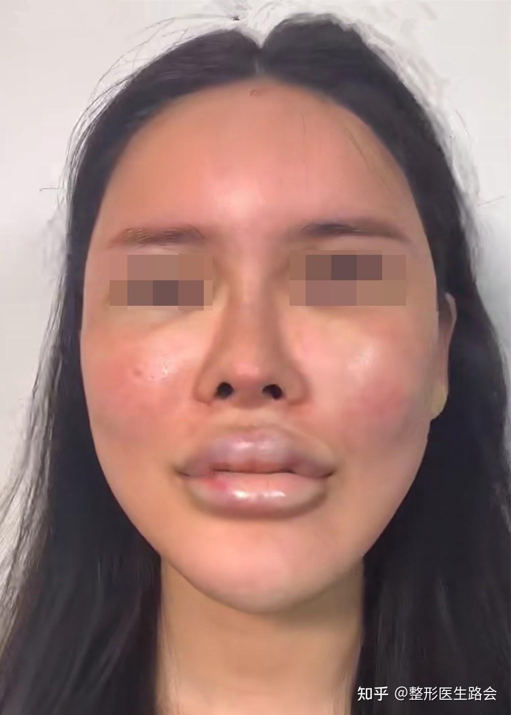 一,玻尿酸填充要慎重!