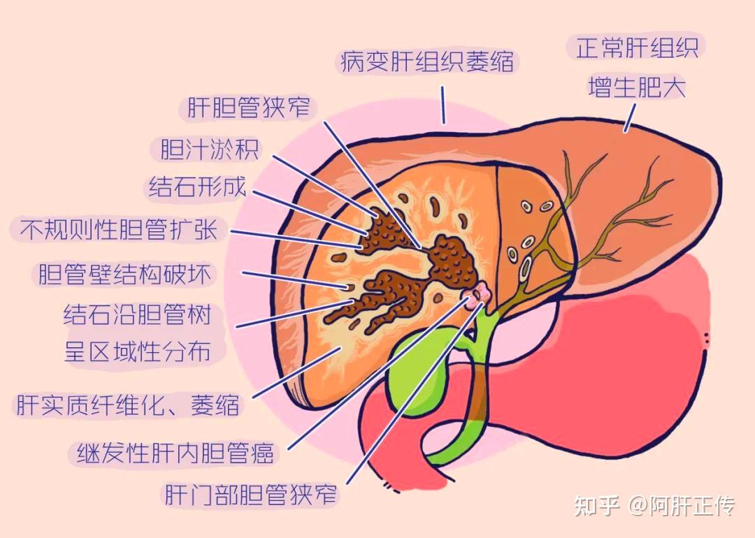 肝内胆管结石图片剖析图片