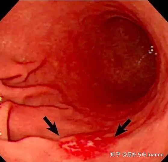 早期胃癌胃镜图片