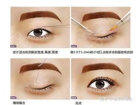 郑大一附院割双眼皮价格_双眼皮的价格_双眼皮价格表图片