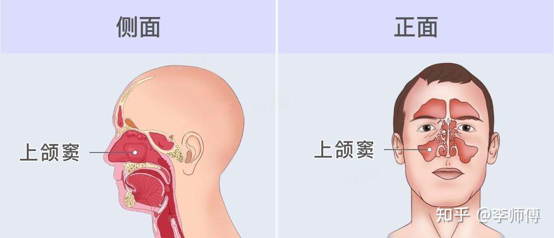 鼻窦炎防治 - 知乎