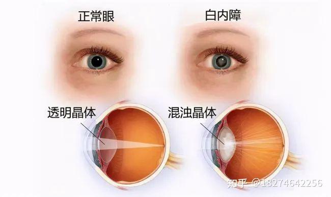 【眼健康科普课堂】青光眼还能和白内障扯上关系? - 知乎