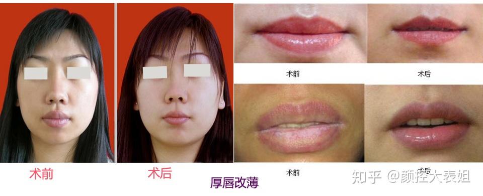 大嘴巴可以整容变成小嘴巴吗?