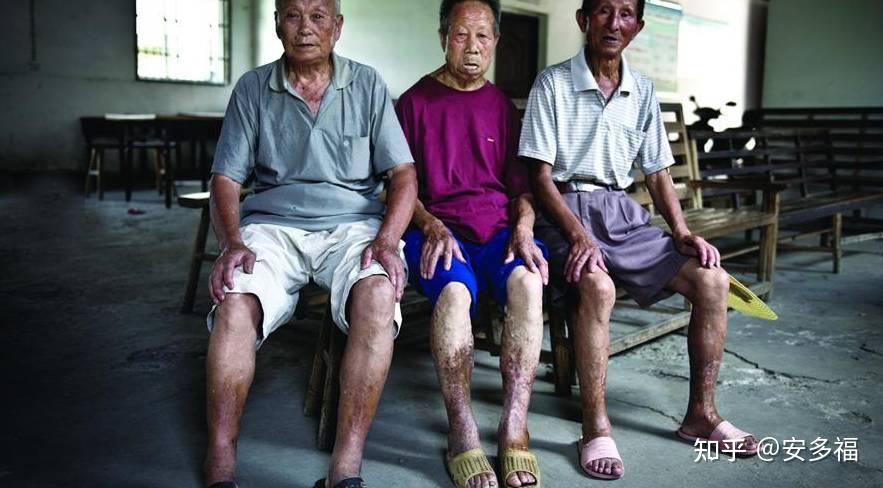 是什么让饱受日军细菌战摧残的"烂脚"老人重获新生?